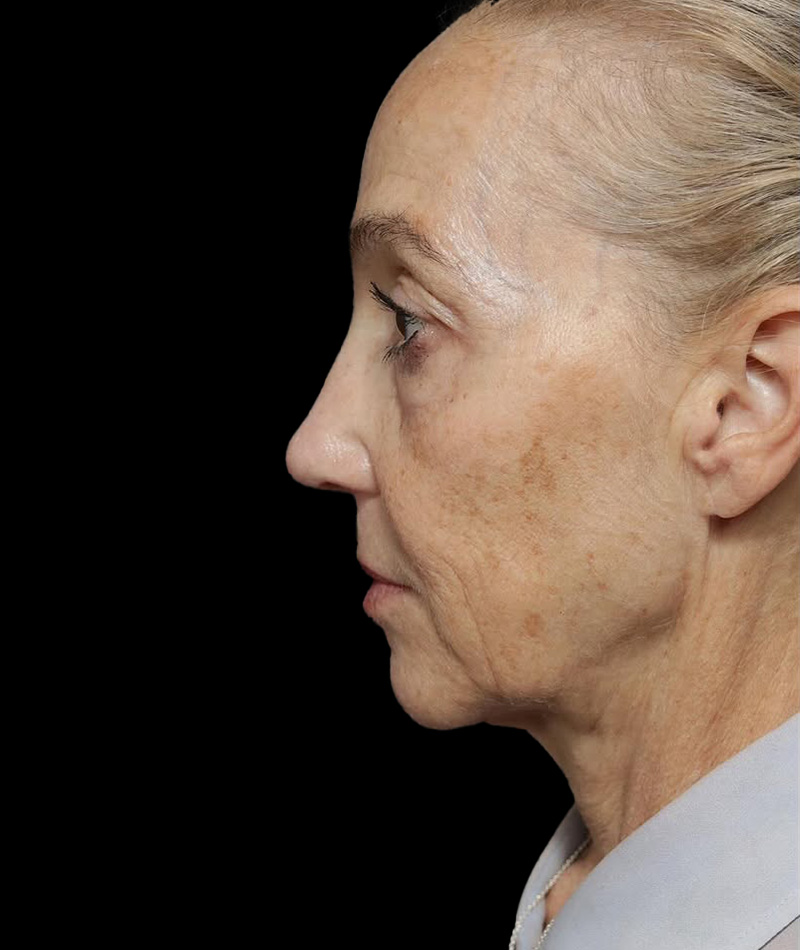 Neck Lift Before Photo #1