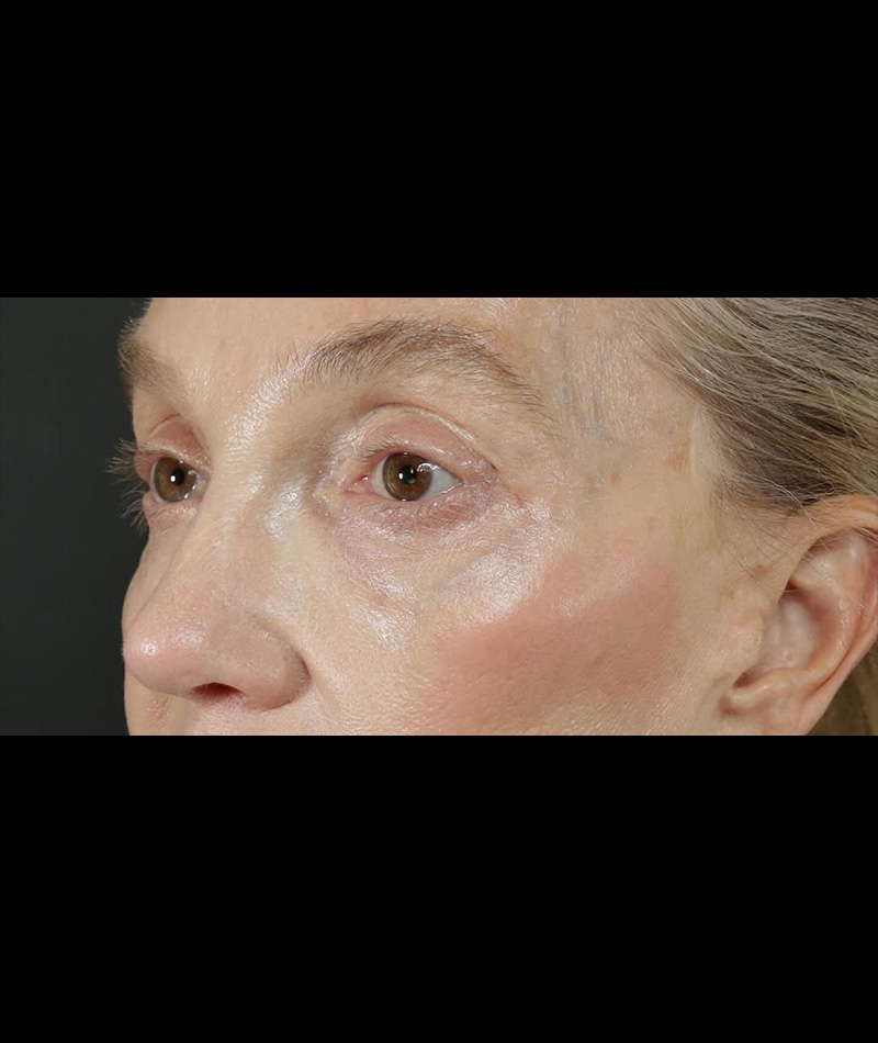 Neck Lift After Photo #10