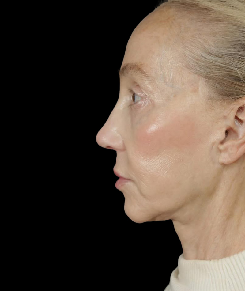 Neck Lift After Photo #2