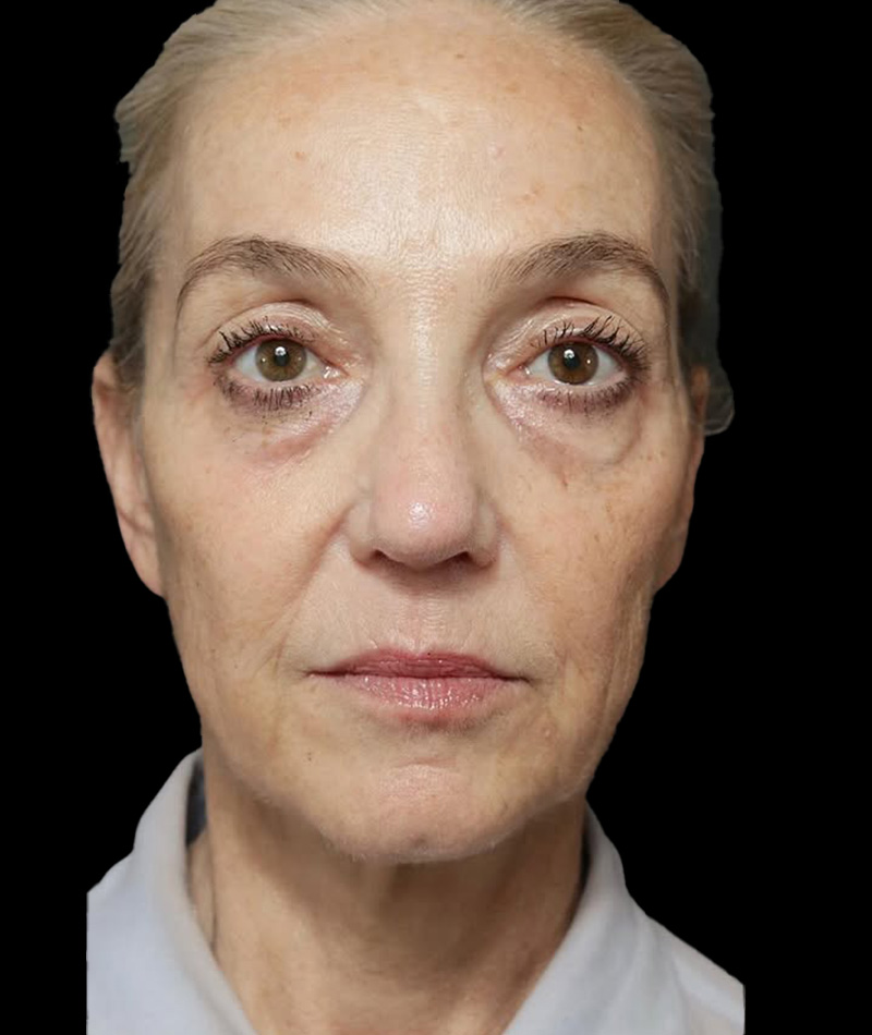 Neck Lift Before Photo #3