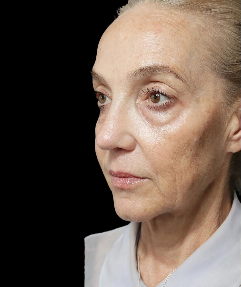 Neck Lift Before Photo #5