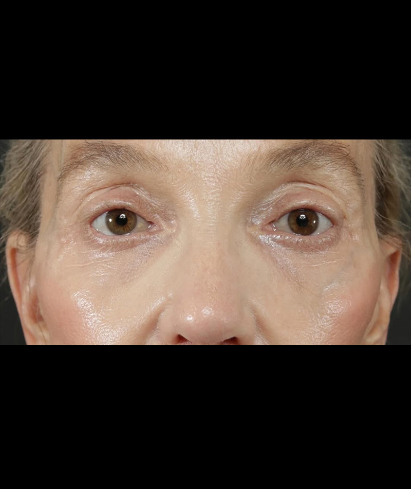 Neck Lift After Photo #8