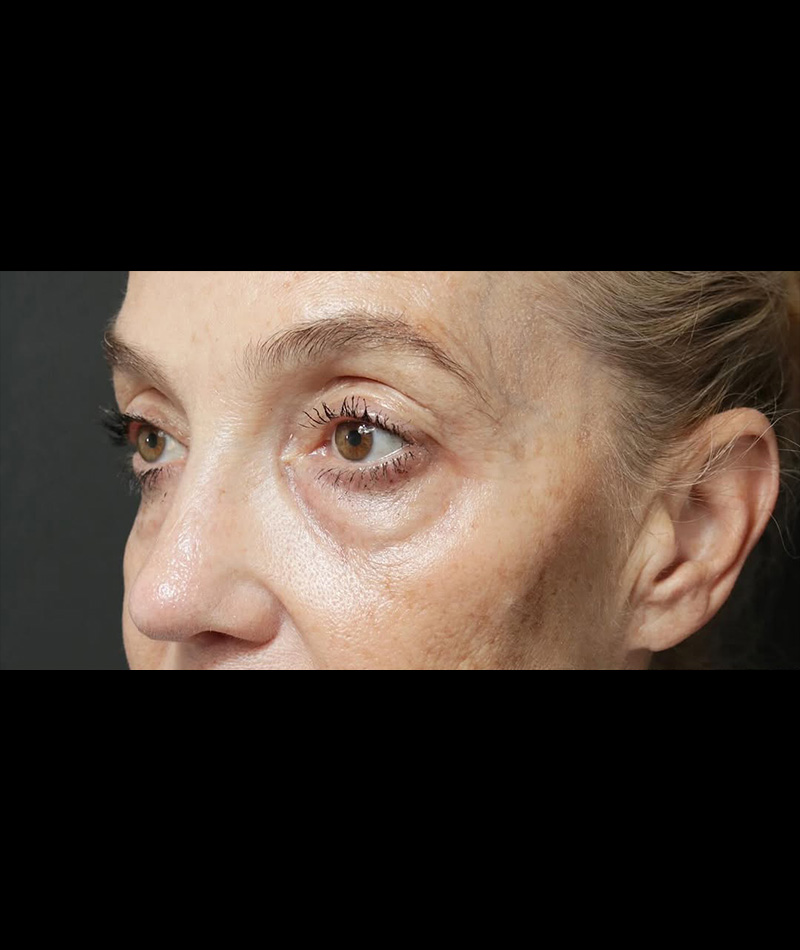 Neck Lift Before Photo #9