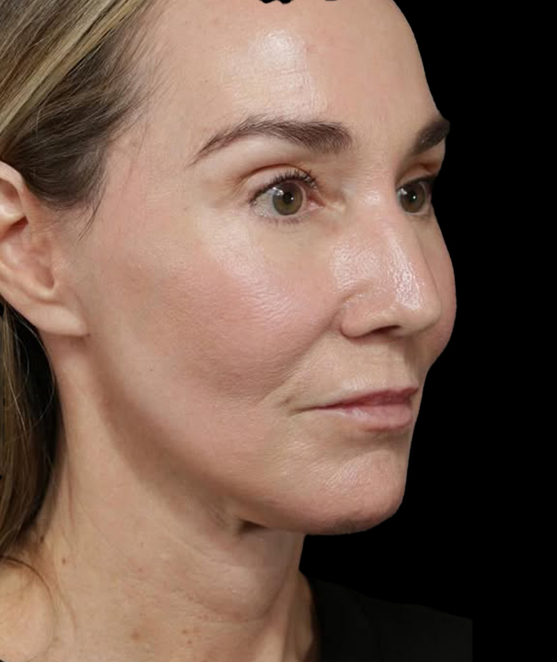 Neck Lift After Photo #10