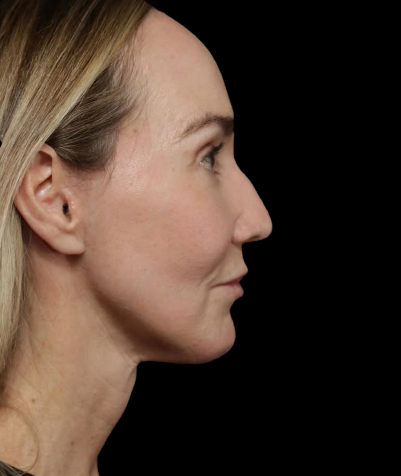 Neck Lift After Photo #2