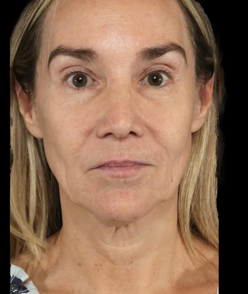 Neck Lift Before Photo #3