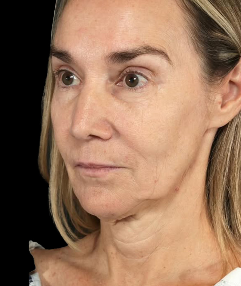 Neck Lift Before Photo #5