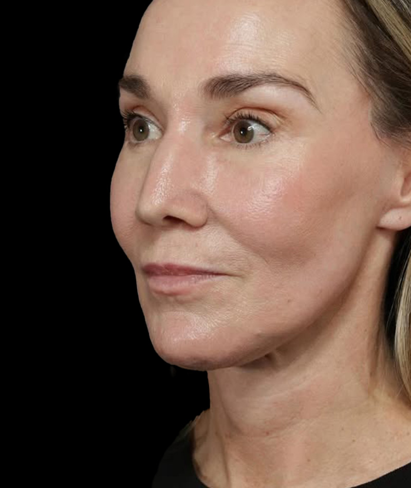 Neck Lift After Photo #6