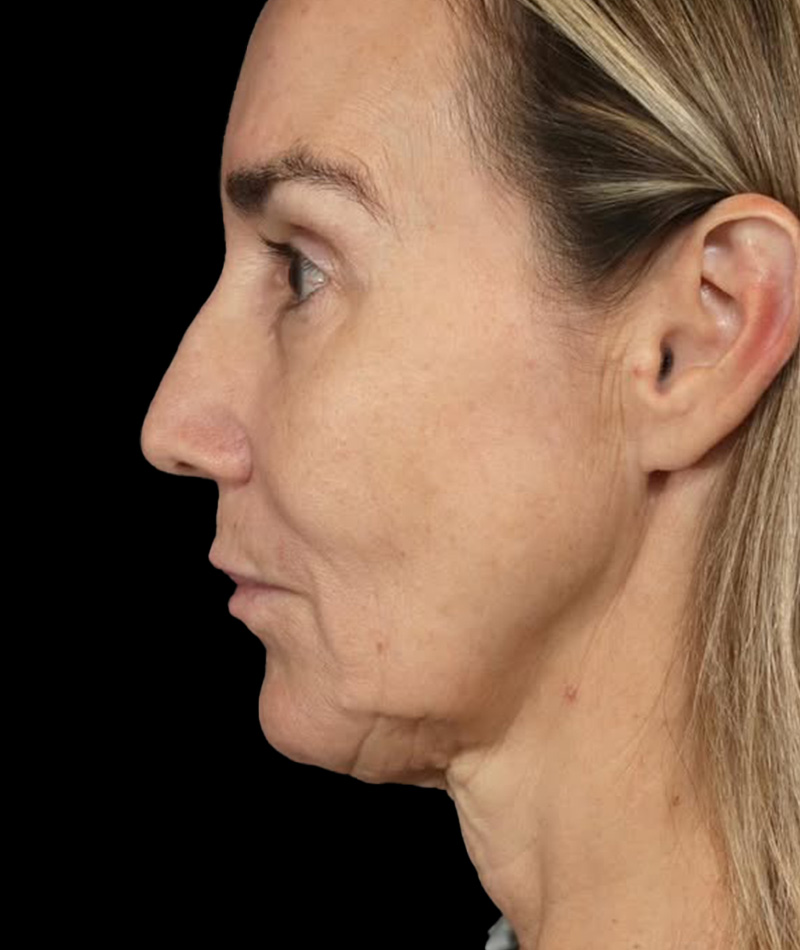 Neck Lift Before Photo #7
