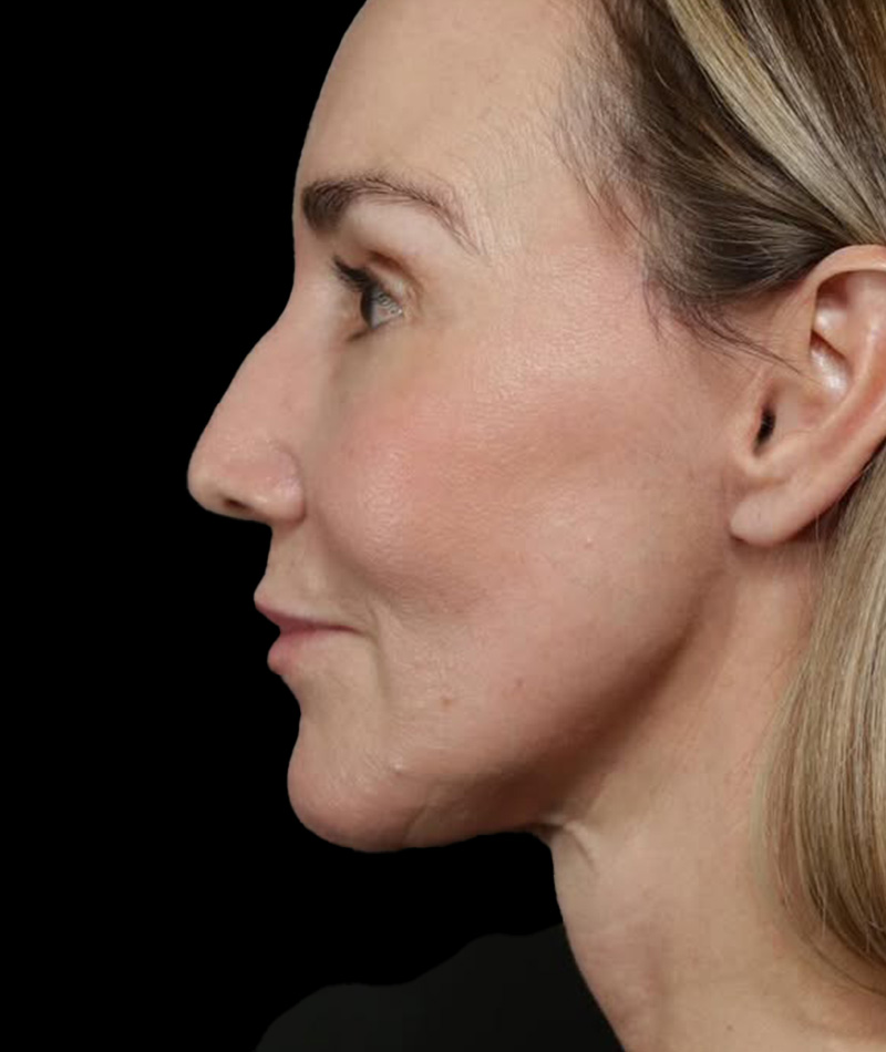 Neck Lift After Photo #8