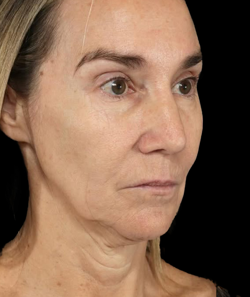 Neck Lift Before Photo #9