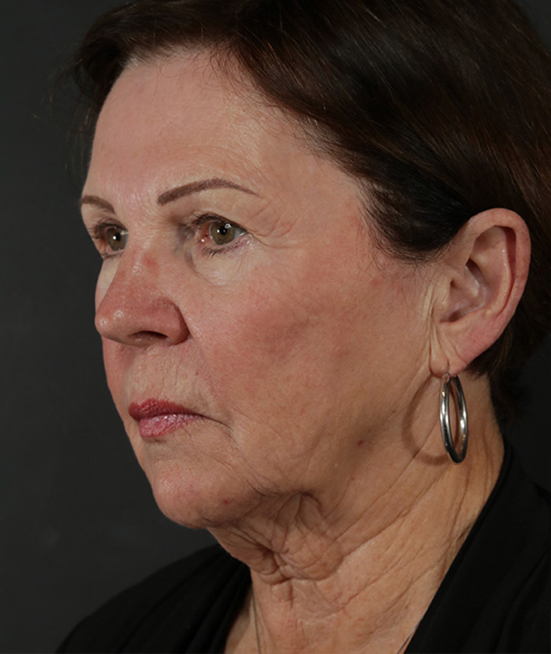 Neck Lift Before Photo #3