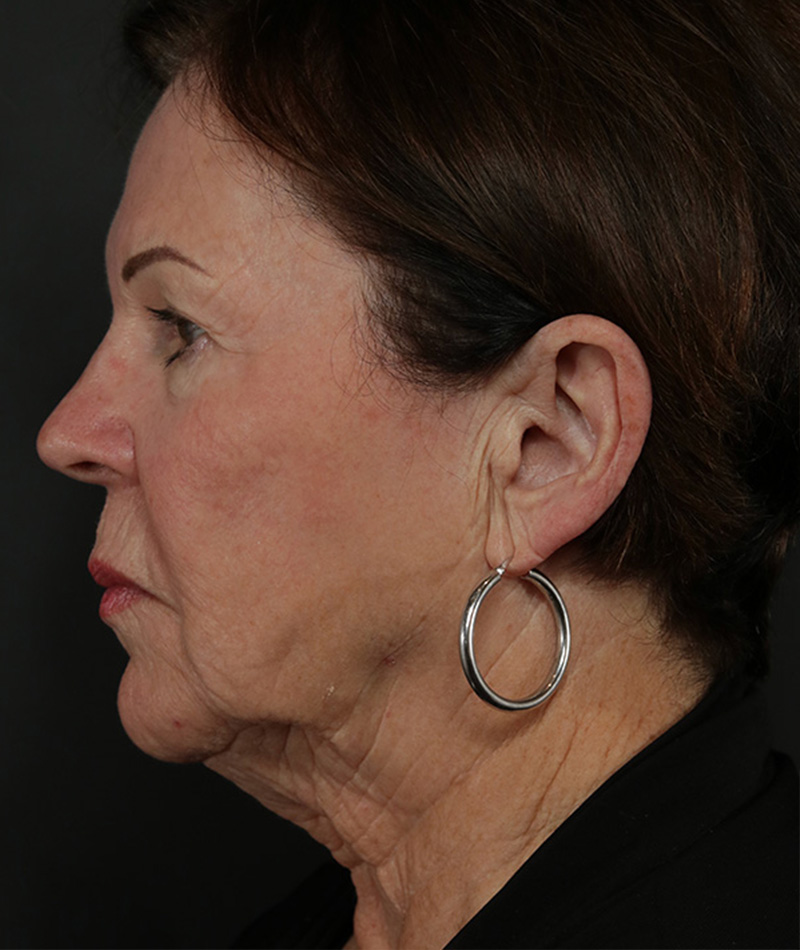 Neck Lift Before Photo #5