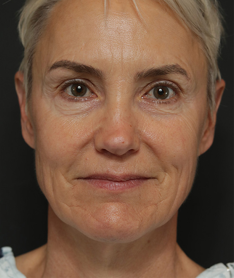 Neck Lift Before Photo #1