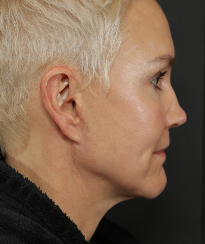 Neck Lift After Photo #6