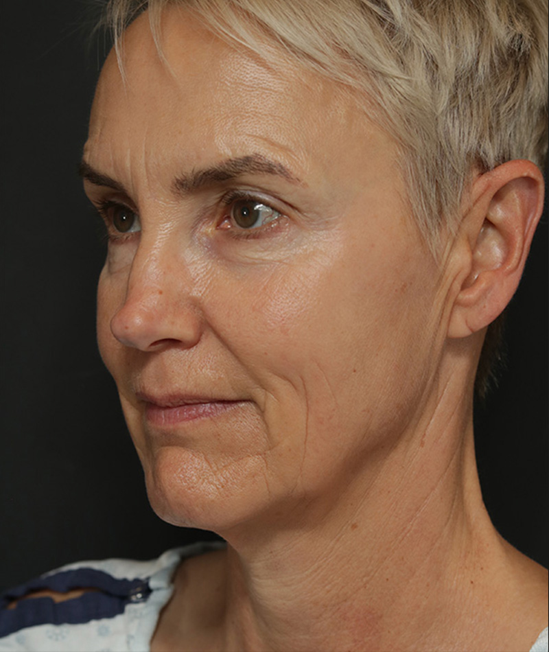 Neck Lift Before Photo #7