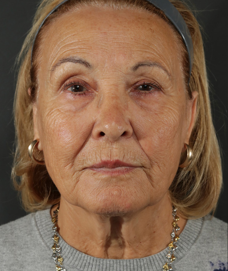 Neck Lift Before Photo #1