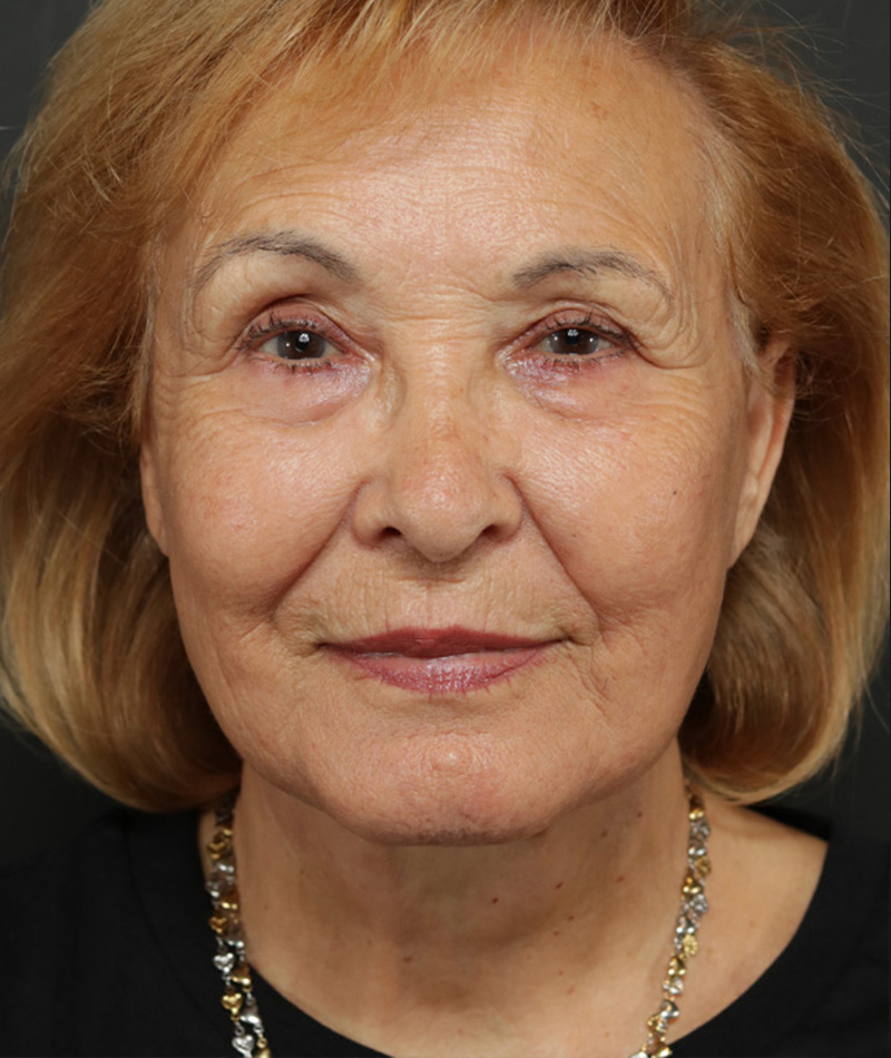 Neck Lift After Photo #2