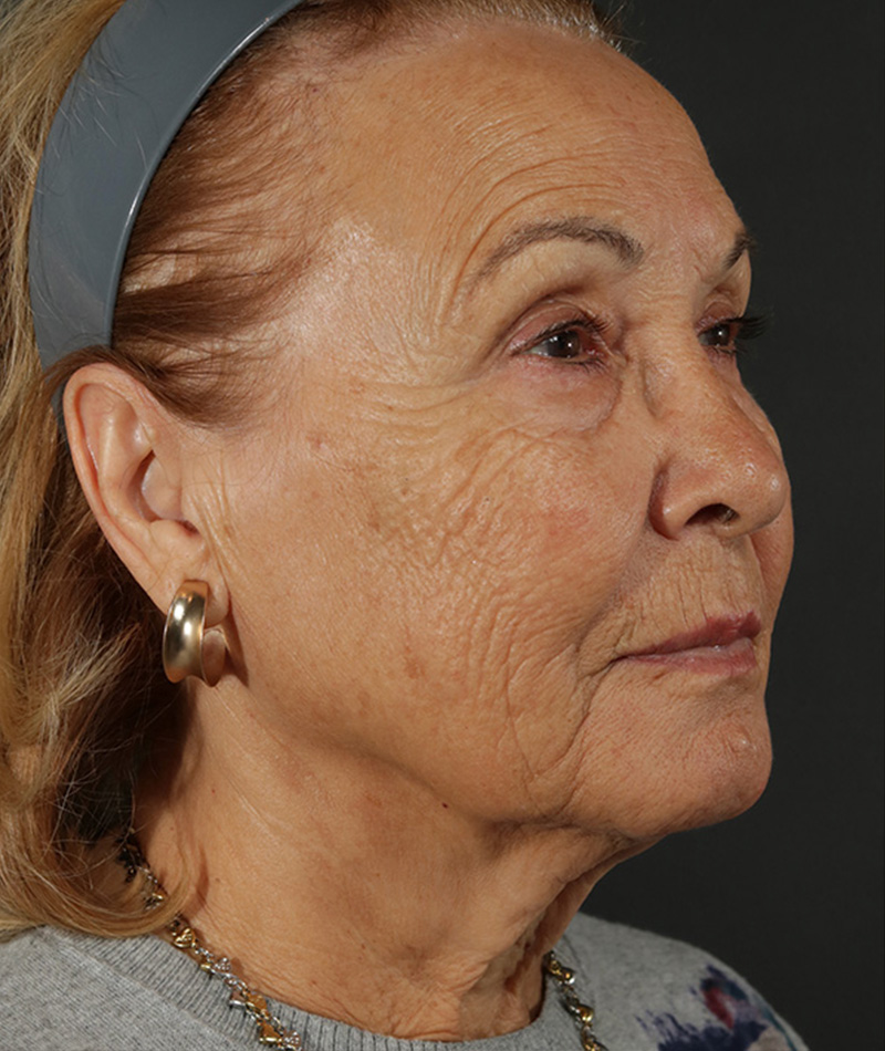 Neck Lift Before Photo #3