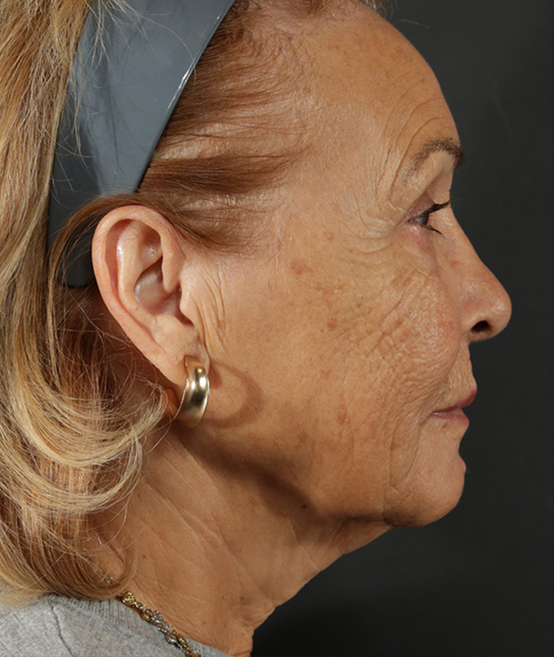 Neck Lift Before Photo #5