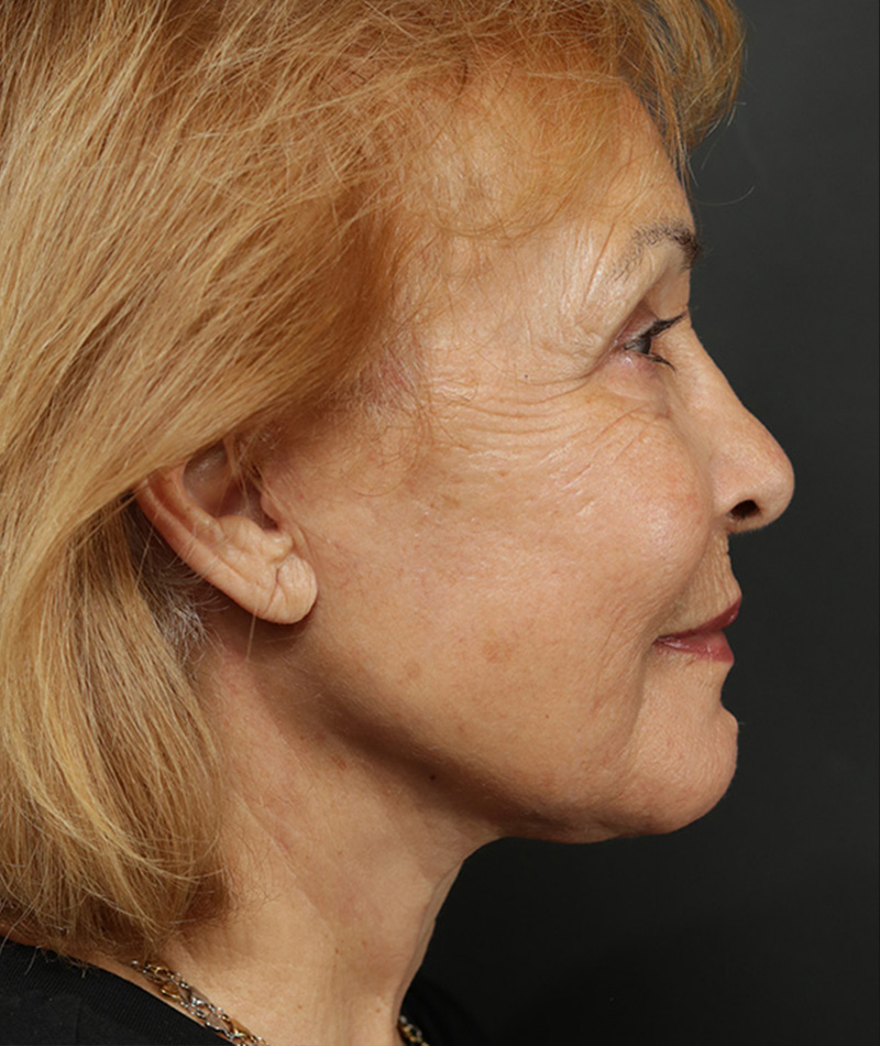 Neck Lift After Photo #6
