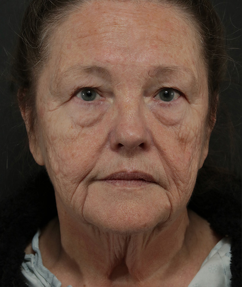 Neck Lift Before Photo #1