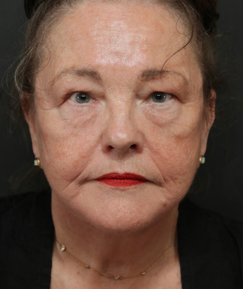 Neck Lift After Photo #2