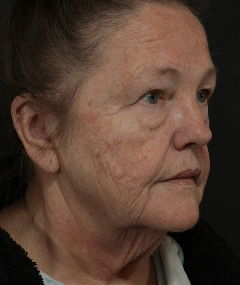 Neck Lift Before Photo #3