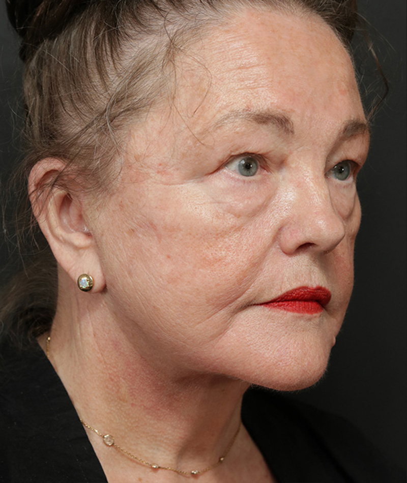 Neck Lift After Photo #4