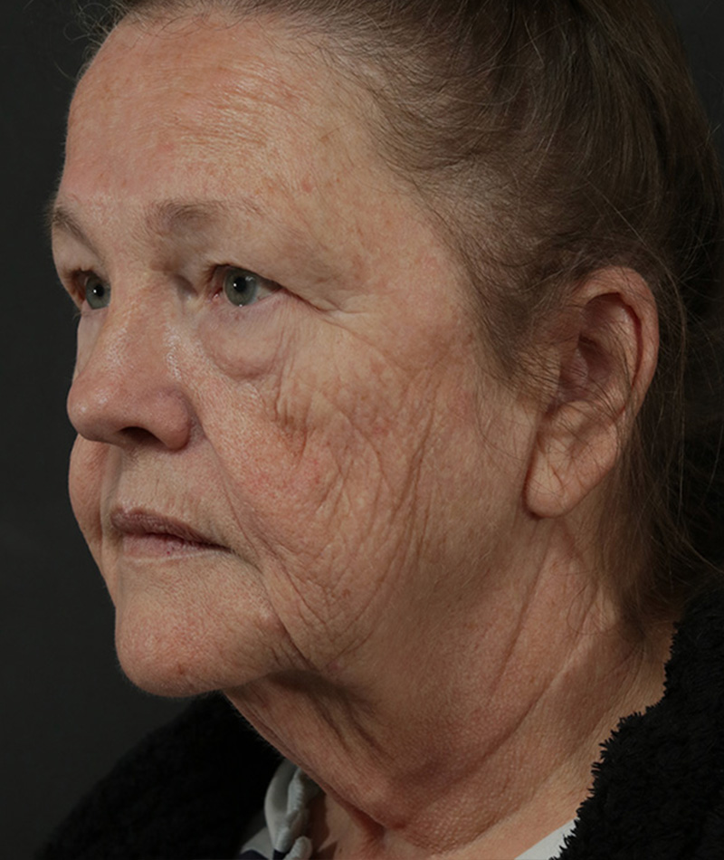 Neck Lift Before Photo #5