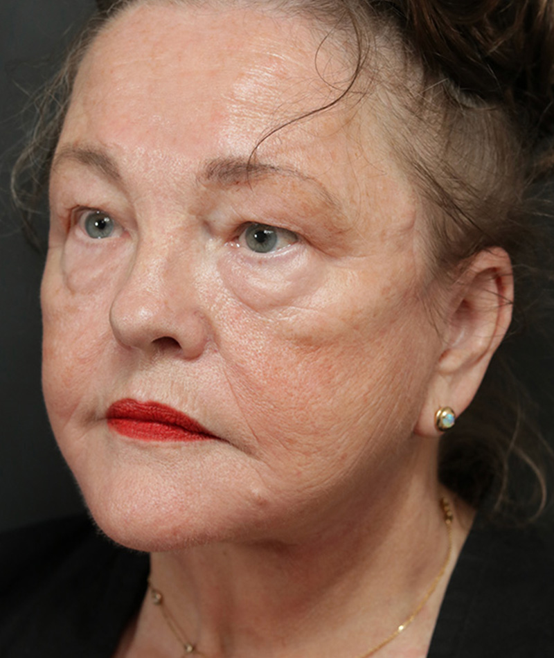 Neck Lift After Photo #6