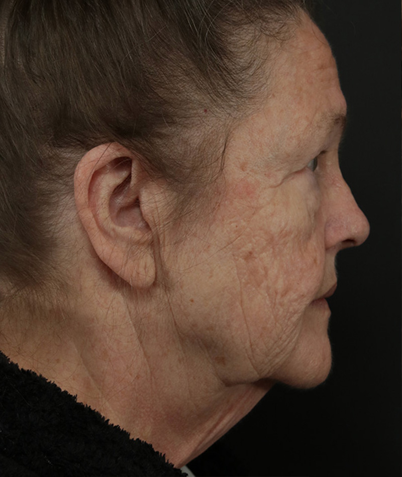Neck Lift Before Photo #7
