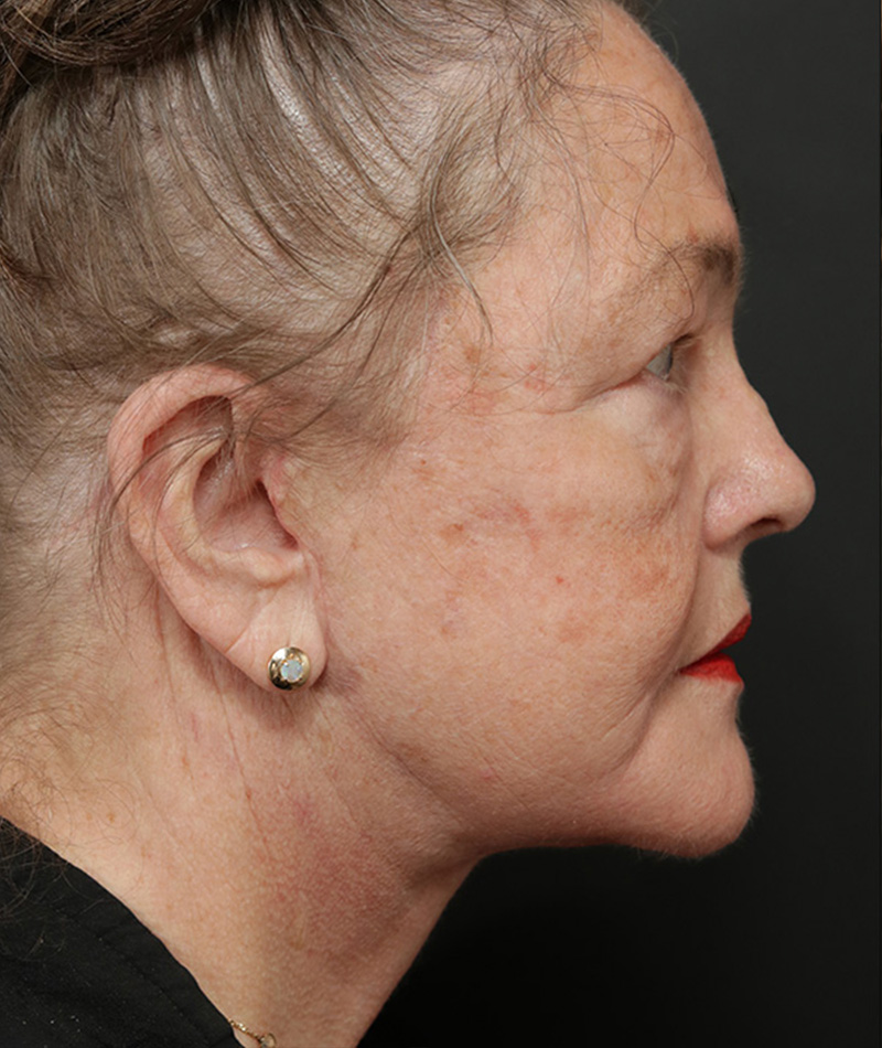 Neck Lift After Photo #8