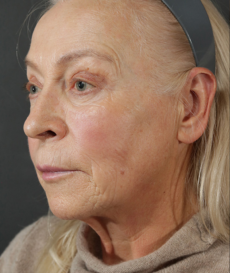 Neck Lift Before Photo #1