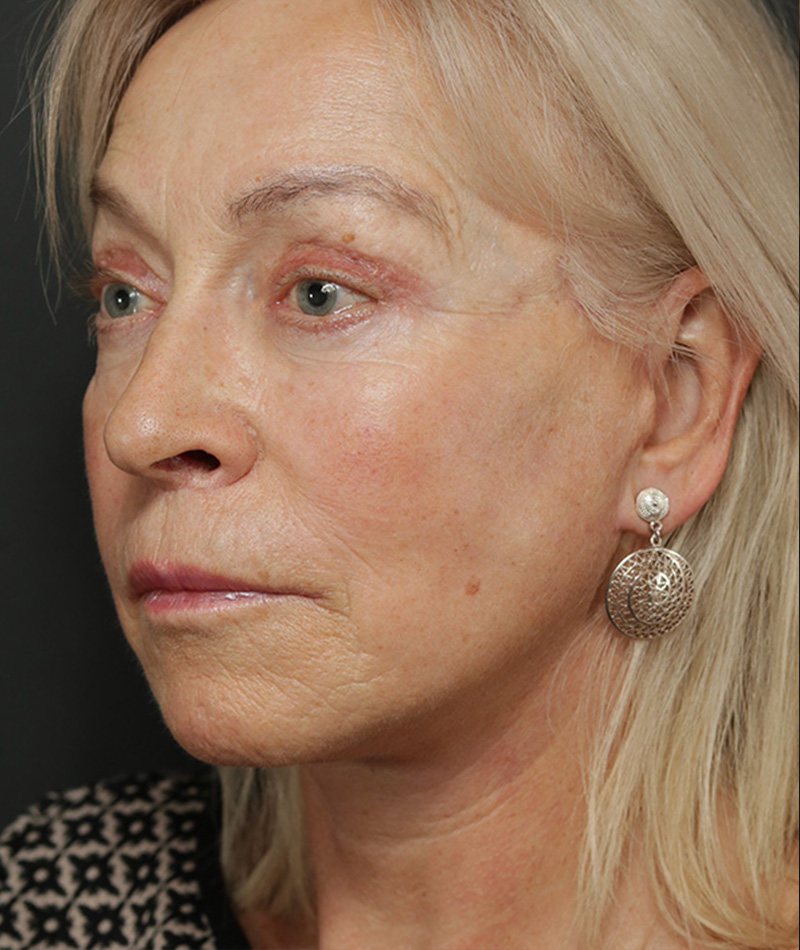 Neck Lift After Photo #2