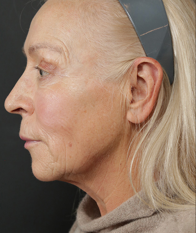 Neck Lift Before Photo #3