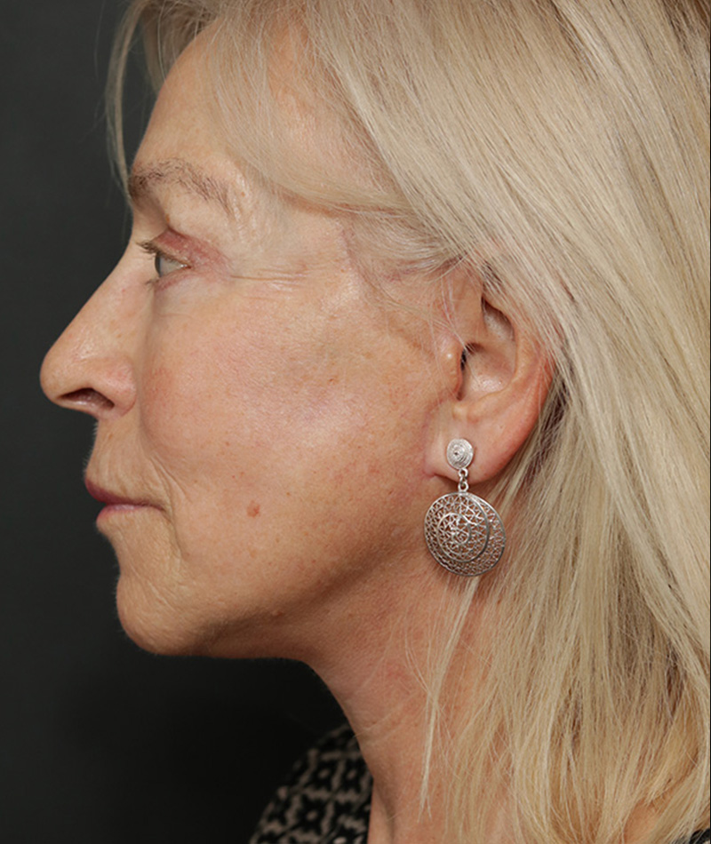 Neck Lift After Photo #4