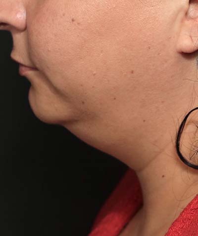 Neck Lift Before Photo #1