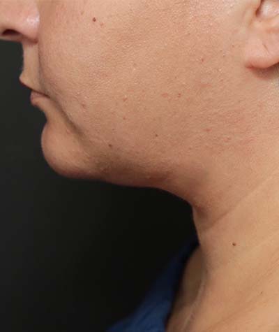 Neck Lift After Photo #2