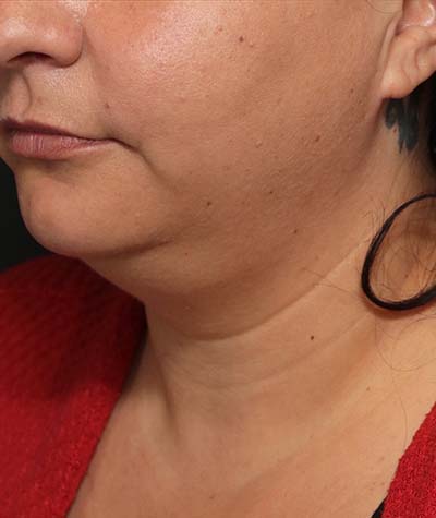 Neck Lift Before Photo #3