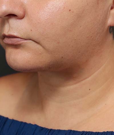 Neck Lift After Photo #4
