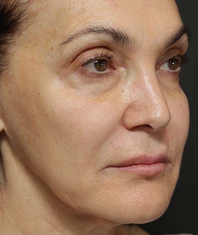 Neck Lift Before Photo #3