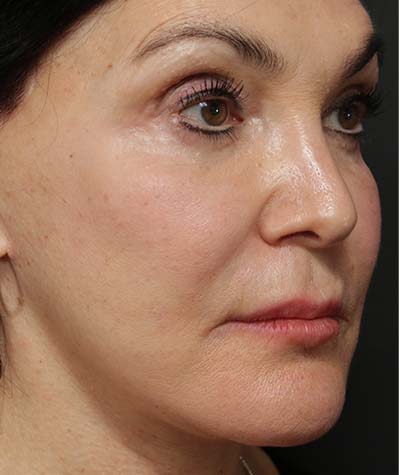 Neck Lift After Photo #4