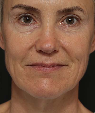 Neck Lift Before Photo #1