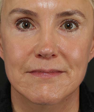 Neck Lift After Photo #2