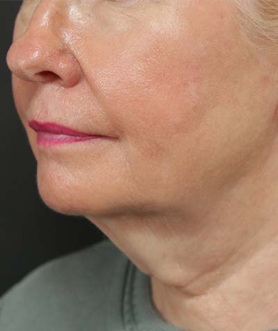 Neck Lift Before Photo #1