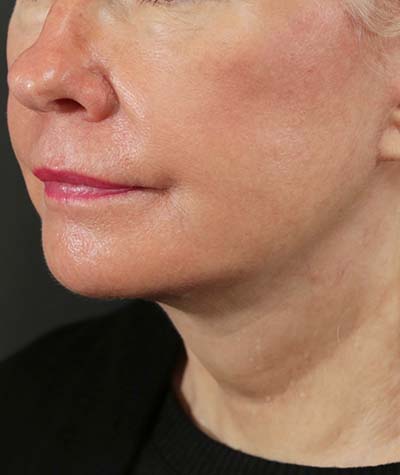 Neck Lift After Photo #2