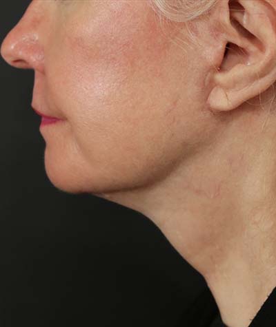 Neck Lift After Photo #4