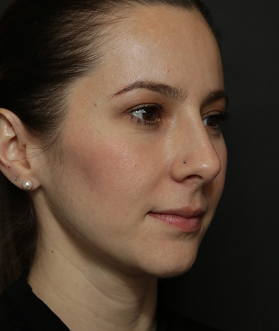 Fillers After Photo #2