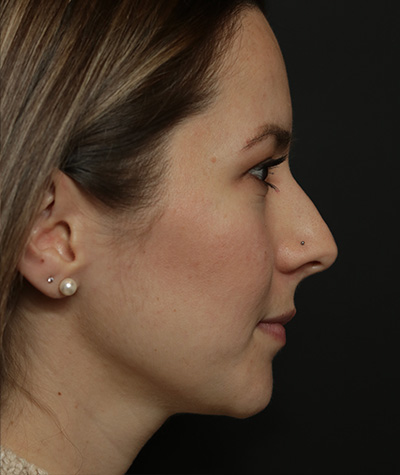 Fillers Before Photo #3